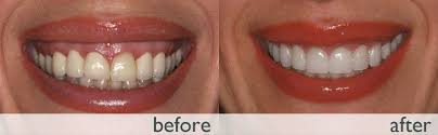 7 how do you fix a gummy smile? Gummy Smile Correction Dental Visit Turkey Serhan Izer Dentist Bds