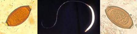 Maybe you would like to learn more about one of these? Cdc Trichuriasis
