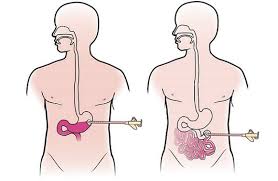 About The Placement Of Your Peg Or Pej Tube For Feeding Memorial Sloan Kettering Cancer Center