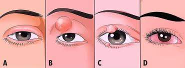 Rojez Y Ardor En Los Ojos La Rosacea Ocular Podria Ser La Culpable