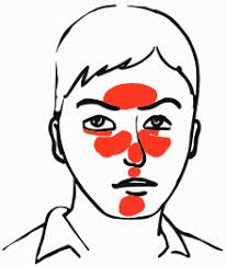 Rhinophym ist eine erkrankung, die die entwicklung einer großen, bauchigen nase verursacht, die mit einer granulomatösen infiltration verbunden ist, üblicherweise aufgrund einer unbehandelten rosacea. Rosazea Wikipedia