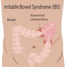 Should the elderly consider colon cancer screening? Treating Irritable Bowel Syndrome