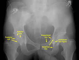 Resad paya pasic the video shows the anatomy of the pelvic sidewall and the relationship of all the anatomical structures. Pelvic X Rays Orthointern