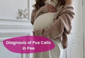 Pyuria (Pus Cells In Urine): Symptoms, Causes, Treatment, Doctor, Medicine,  Prevention, Diagnosis