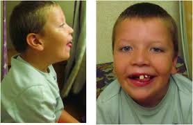 Novel protein-truncating variants of a chromatin-modifying gene MSL2 in  syndromic neurodevelopmental disorders