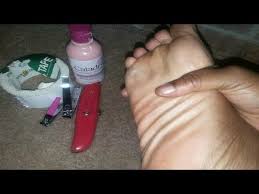 Getting Rid Of A Plantar Wart Foot Callus Youtube