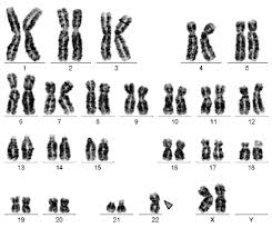 A robertsonian translocation effects acrocentric chromosomes. De Novo Balanced Robertsonian Translocation Rob 22 22 Q10 Q10 In A Woman With Recurrent Pregnancy Loss A Rare Case