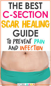 The surgeon sews up the incision in the mother's abdomen. C Section Scar Healing Care Guide Stork Mama
