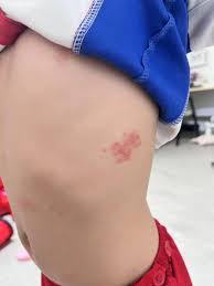 Image result for shingles in children