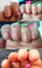 São pacientes que tiveram covid. Eu Testei Varios Remedios Para Combater As Micoses Das Unhas Mulherup Lace Wig Perucas Lace De Luxo
