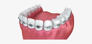 I thought you only got certain bands of treatment free. Braces Dental Braces Free Transparent Png Download Pngkey