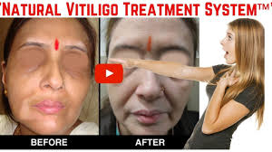 How To Cure Vitiligo Fast Natural Vitiligo Treatment System Youtube