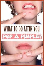 What To Do After You Pop A Pimples Acne Scar Removal Pimples Pimples Remedies