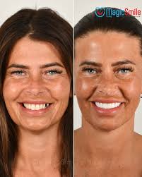 Treatment Details: 23 Zirconium Crown 3 Dental Implants Free Consultation ✓  Free Hotel Stay 🛎 Free Transfer Services (Airport