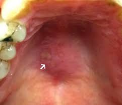 Image result for Oral herpes roof of mouth