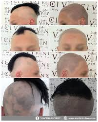 Pin On Scalp Micro Pigmentation