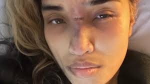 13 Investigates: Cosmetic patient sues doctor, nurse after injection  blinded eye