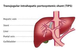 Diagram of the liver liver directed therapies for primarymetastatic hepatic malignancies clancy clark md. Transjugular Intrahepatic Portosystemic Shunt Tips Cirse