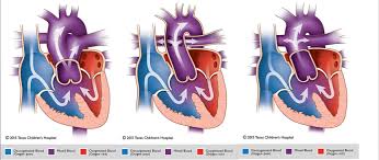Truncus Arteriosus Pediatric Echocardiography
