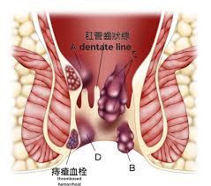 Image result for hemoroid human