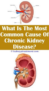 3 Complete Simple Ideas Kidney Disease Rash Pictures Low Blood Pressure And Chronic Kidney Di Kidney Disease Kidney Disease Symptoms Polycystic Kidney Disease