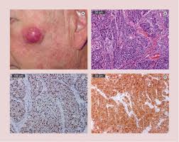 Your doctor will check for lumps, lesions, or irregularly merkel cell carcinoma is considered an aggressive type of cancer. Rationale For Immune Based Therapies In Merkel Polyomavirus Positive And Negative Merkel Cell Carcinomas Immunotherapy