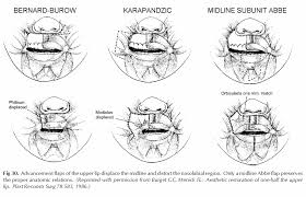 An old flap for reconstruction of lower lip defects due to lower lip carcinoma resection. Https Nanopdf Com Download Lip Reconstruction Pdf