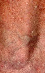 Particularly, to the untrained eye, any benign skin tumour—pigmented or nonpigmented—is easily mistaken for a malignant lesion. Stucco Keratosis Keratosis Alba Dermatology Advisor