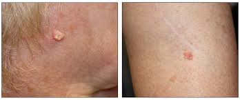 Learn how to recognize the signs of melanoma carcinoma skin cancer in this free health care video.expert: Genetics Of Skin Cancer Pdq Pdq Cancer Information Summaries Ncbi Bookshelf