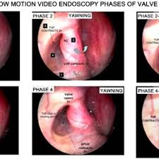 Check spelling or type a new query. Pdf Long Term Outcomes Of Cross Hatching Eustachian Tuboplasty