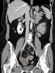 When the tissue grows abnormally outside the uterus, such as on the bowel, the endometrial tissue still thickens in a ct scan. Cureus Endometriosis Of The Vermiform Appendix Presenting As Acute Appendicitis