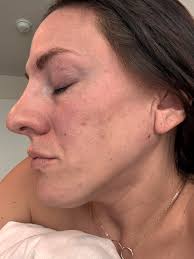 What face oil recommendations are there for PIE?