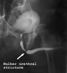 Image result for Retrograde Urethrogram