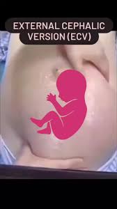 Image result for External Cephalic Version