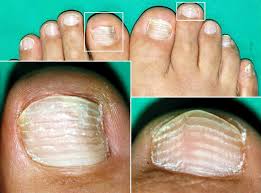 Image result for Muehrcke Line