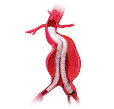 Learn vocabulary, terms and more with flashcards, games and other study tools. Interventia Endovasculara Pentru Anevrismul De Aorta Abdominala Evar Arterra