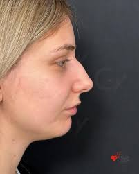 With secondary rhinoplasty, there is always the second option for problems  that arise as a result of the previous rhinoplasty! Second operations may  be more difficult because your nose structure changes due