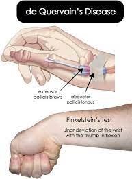 The finkelstein test is used to help diagnose de quervain's tenosynovitis for patients who are experiencing wrist pain. Rosh Review Medical Anatomy Medical Knowledge Physical Therapist Assistant