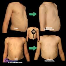 Image result for Pectus Excavatum