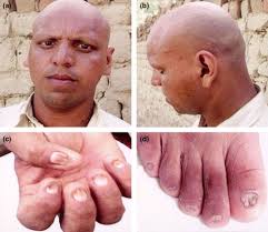 Clinical presentation of ED of the hair and nails in the affected...