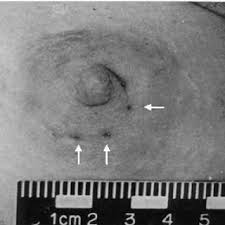 Onde, desde que foi publicado, o baixar bites de raper book foi muito procurado pelos fãs, devido ao conteúdo de alta qualidade. A Photograph Showing An Odd Bitemark On The Rape And Murder Victim S Download Scientific Diagram