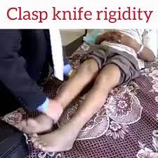 We did not find results for: Ø§ÙØ·Ø¨ Ø¨Ø¨Ø³Ø§Ø·Ø© On Twitter Clasp Knife Spasticity Describes The Phenomenon In A Spastic Limb Where After An Initial Resistance To Passive Movement Of A Joint There Is A Sudden Reduction In Tone