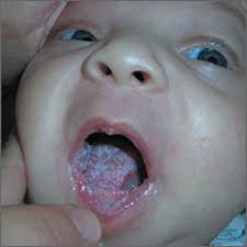 Gently open your baby's mouth, and then lightly rub their tongue in a circular motion using the cloth or gauze. White Coating On Infant S Tongue Mdedge Family Medicine