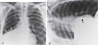 Loculated effusions occur most commonly in association with conditions that cause intense pleural. Pleural Effusion With Atelectasis Drone Fest