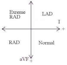 Image result for Right Axis Deviation