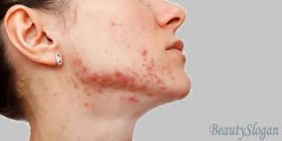 Everything you'll need to get rid of acne scars may be found in your home or the market, such as: How To Fade Red Acne Scars Novocom Top