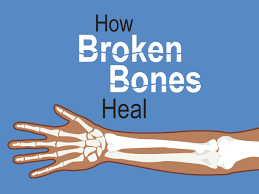 How long does a broken wrist take to heal. Broken Bones For Parents Nemours Kidshealth