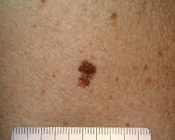 For the most part, skin cancers are acquired through sun exposure so are more environmental rather than genetic. Skin Cancer Epidemic