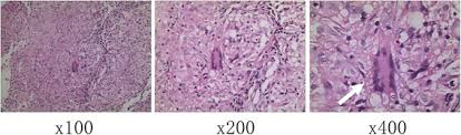 Sarcoidosis in the lungs is called pulmonary sarcoidosis. Sarcoidosis Misdiagnosed As Malignant Tumors A Case Report World Journal Of Surgical Oncology Full Text