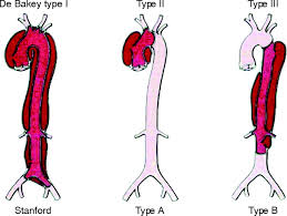 Image result for Aortic Dissection